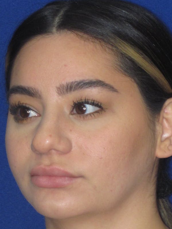 Rhinoplasty Before & After Gallery - Patient 367952 - Image 7