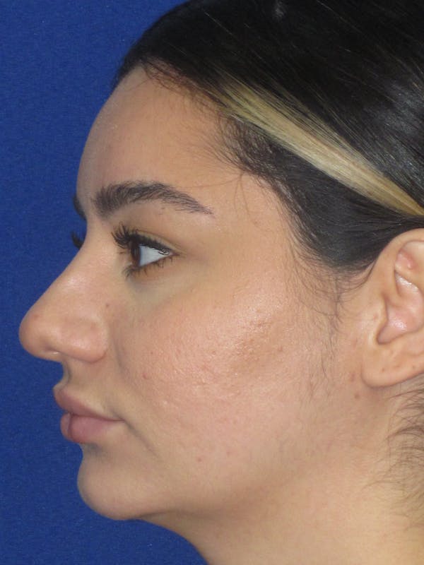 Rhinoplasty Before & After Gallery - Patient 367952 - Image 9