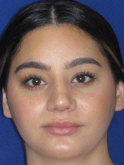 Rhinoplasty Before & After Gallery - Patient 367952 - Image 2