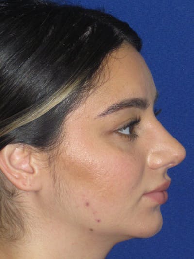 Rhinoplasty Before & After Gallery - Patient 367952 - Image 6