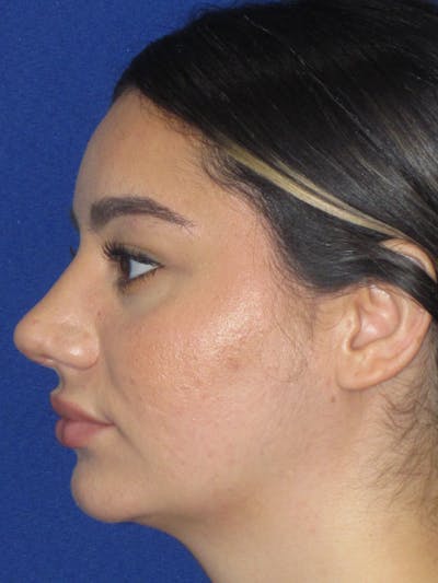 Rhinoplasty Before & After Gallery - Patient 367952 - Image 10