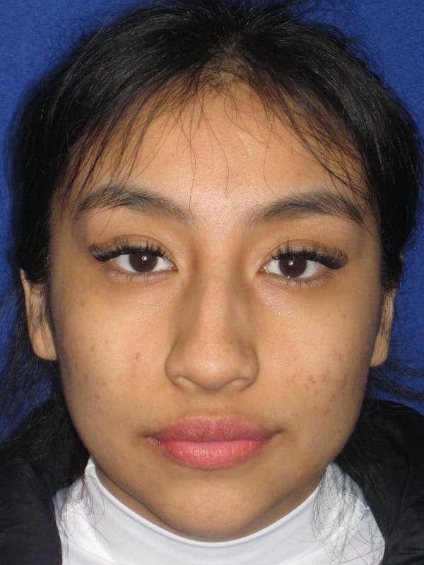 Rhinoplasty Before & After Gallery - Patient 156049 - Image 3