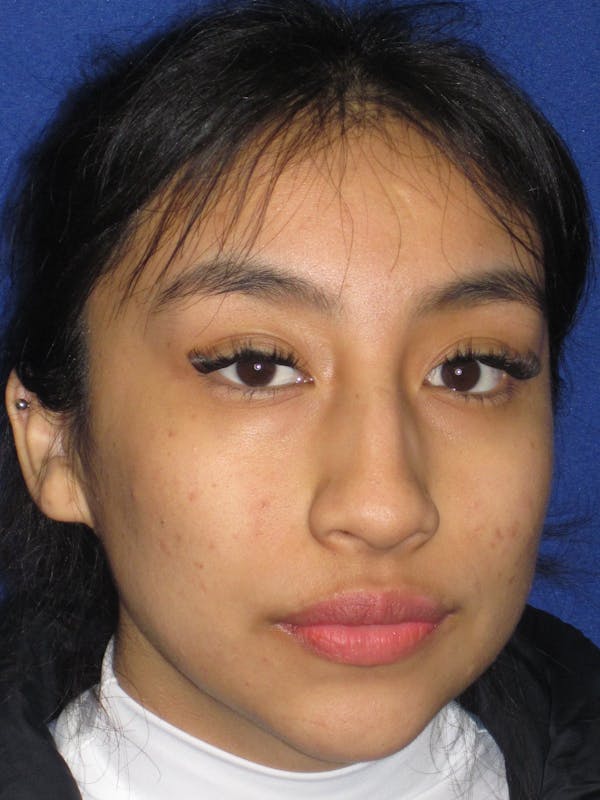 Rhinoplasty Before & After Gallery - Patient 156049 - Image 5