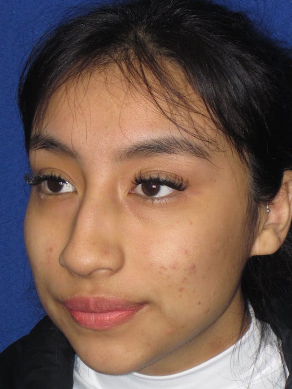Rhinoplasty Before & After Gallery - Patient 156049 - Image 7