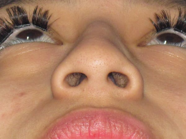 Rhinoplasty Before & After Gallery - Patient 156049 - Image 9