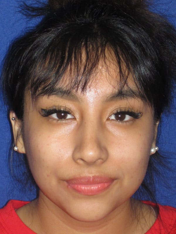 Rhinoplasty Before & After Gallery - Patient 156049 - Image 4