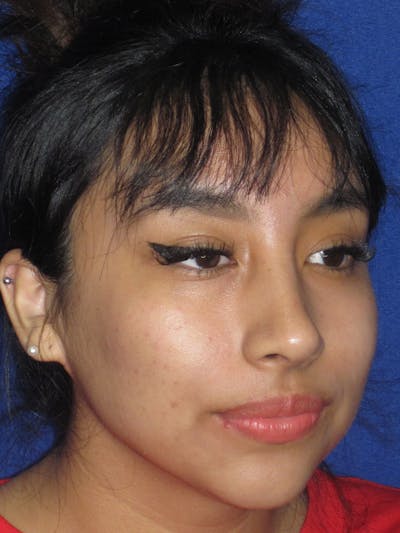 Rhinoplasty Before & After Gallery - Patient 156049 - Image 6