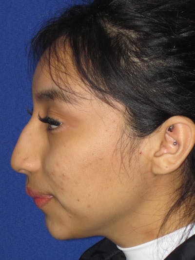 Rhinoplasty Before & After Gallery - Patient 156049 - Image 1