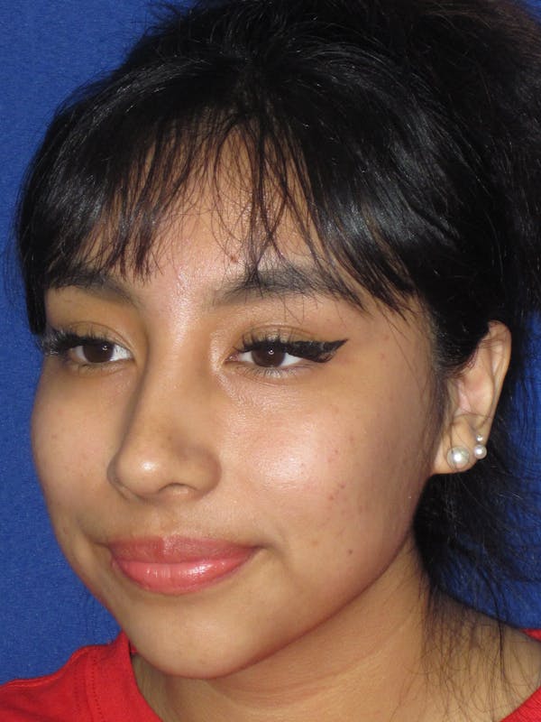 Rhinoplasty Before & After Gallery - Patient 156049 - Image 8