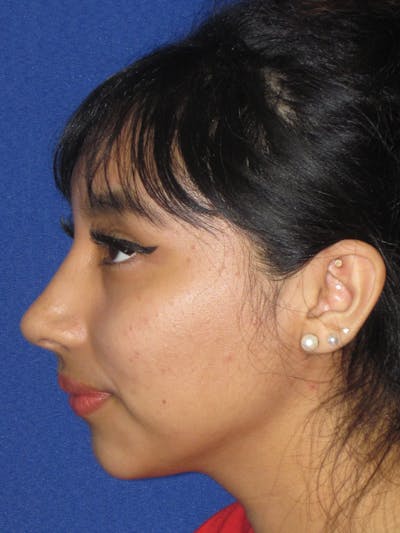 Rhinoplasty Before & After Gallery - Patient 156049 - Image 2