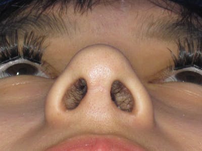 Rhinoplasty Before & After Gallery - Patient 156049 - Image 10