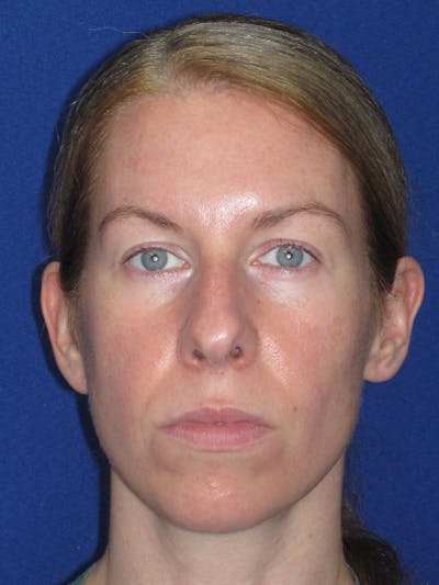 Rhinoplasty Before & After Gallery - Patient 470278 - Image 1