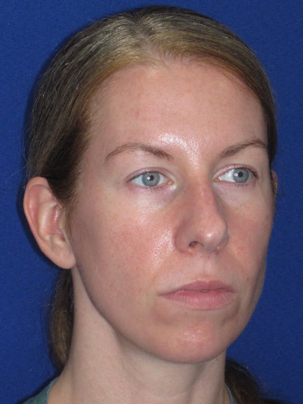 Rhinoplasty Before & After Gallery - Patient 470278 - Image 3