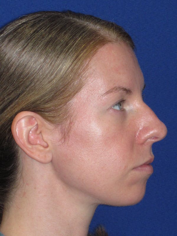 Rhinoplasty Before & After Gallery - Patient 470278 - Image 5