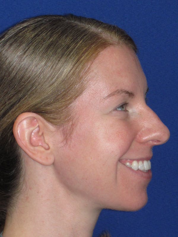 Rhinoplasty Before & After Gallery - Patient 470278 - Image 7