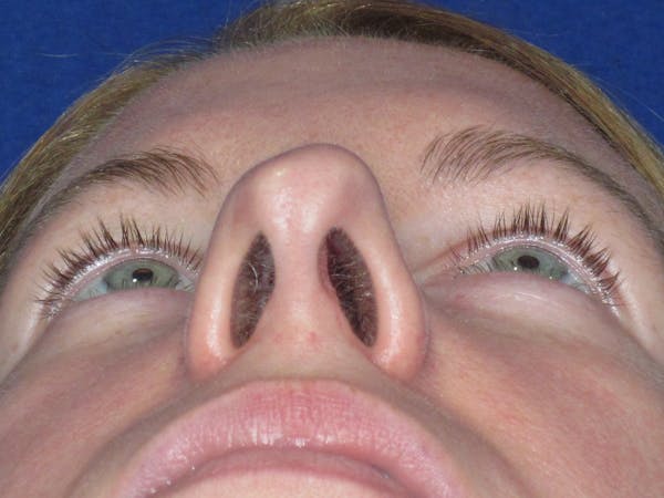 Rhinoplasty Before & After Gallery - Patient 470278 - Image 11