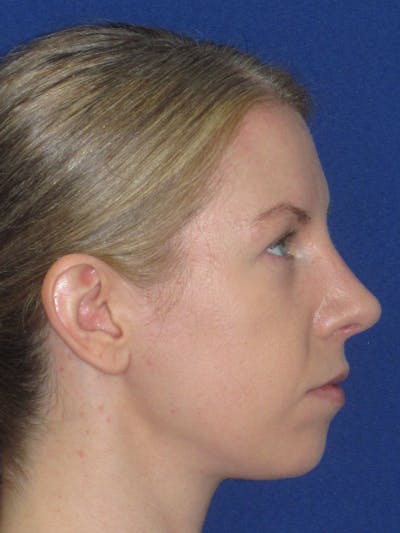 Rhinoplasty Before & After Gallery - Patient 470278 - Image 6