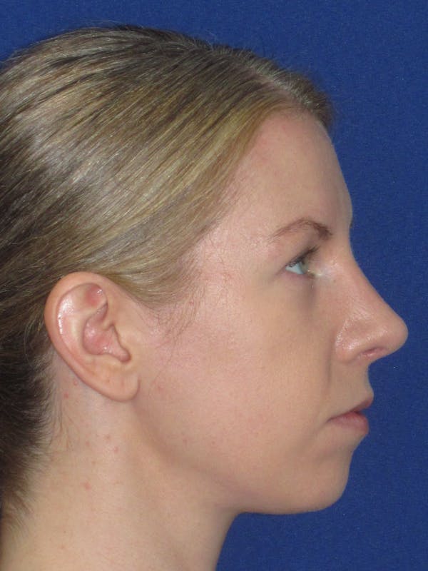 Rhinoplasty Before & After Gallery - Patient 470278 - Image 6