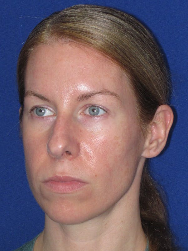 Rhinoplasty Before & After Gallery - Patient 470278 - Image 9
