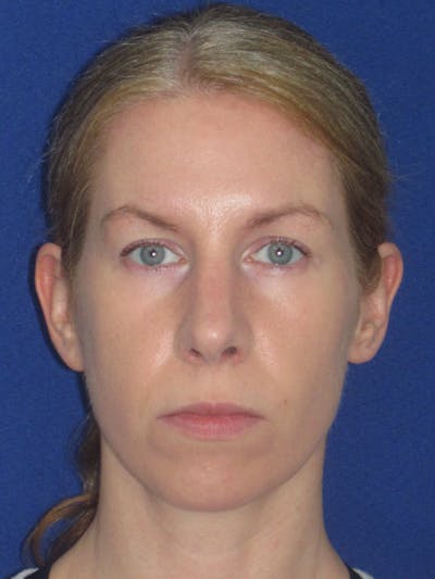 Rhinoplasty Before & After Gallery - Patient 470278 - Image 2
