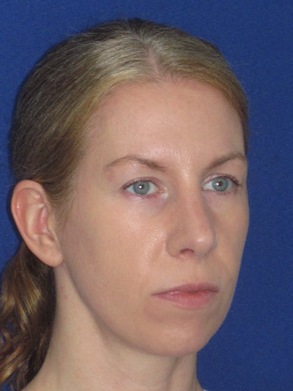 Rhinoplasty Before & After Gallery - Patient 470278 - Image 4