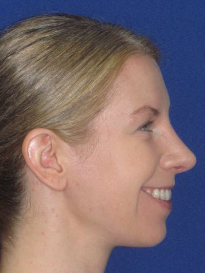 Rhinoplasty Before & After Gallery - Patient 470278 - Image 8