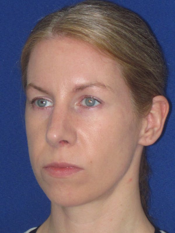 Rhinoplasty Before & After Gallery - Patient 470278 - Image 10
