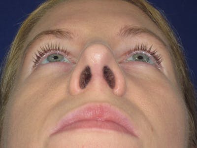Rhinoplasty Before & After Gallery - Patient 470278 - Image 12