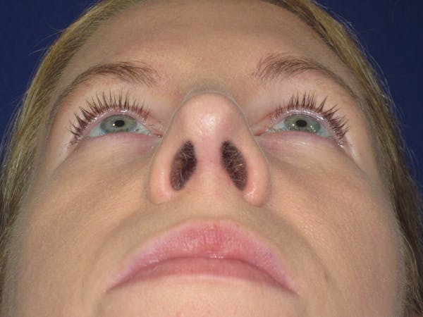 Rhinoplasty Before & After Gallery - Patient 470278 - Image 12