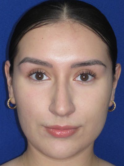 Rhinoplasty Before & After Gallery - Patient 641626 - Image 1