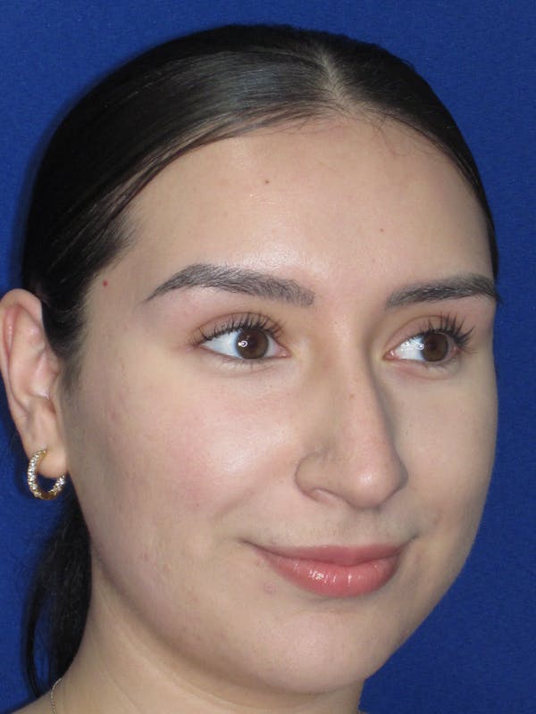 Rhinoplasty Before & After Gallery - Patient 641626 - Image 3