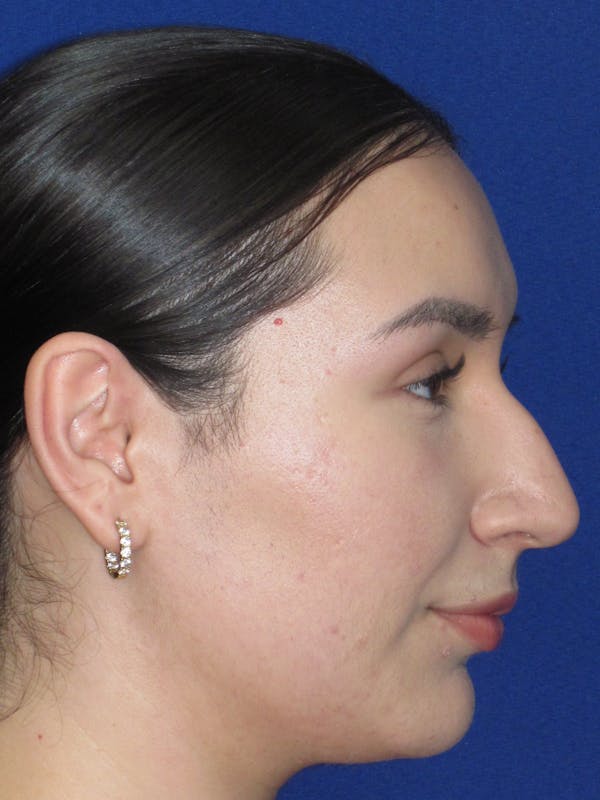 Rhinoplasty Before & After Gallery - Patient 641626 - Image 5