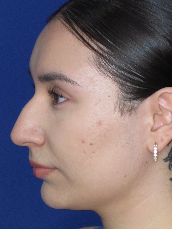 Rhinoplasty Before & After Gallery - Patient 641626 - Image 11
