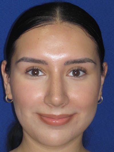 Rhinoplasty Before & After Gallery - Patient 641626 - Image 2