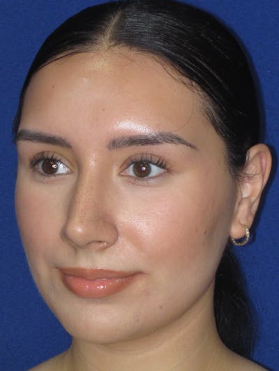 Rhinoplasty Before & After Gallery - Patient 641626 - Image 10