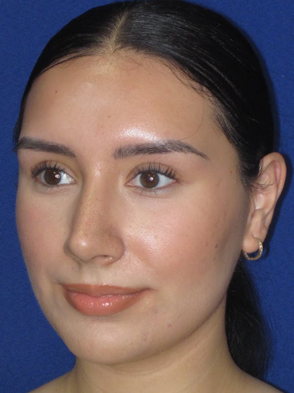 Rhinoplasty Before & After Gallery - Patient 641626 - Image 10