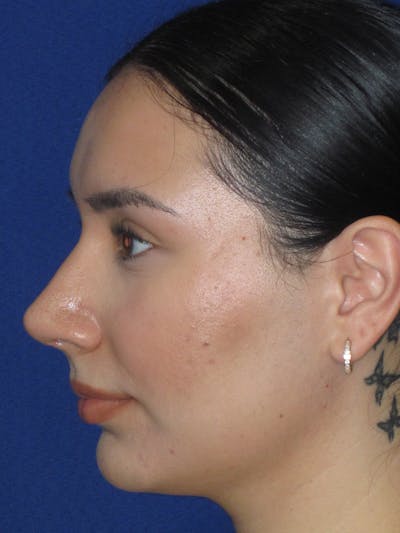Rhinoplasty Before & After Gallery - Patient 641626 - Image 12