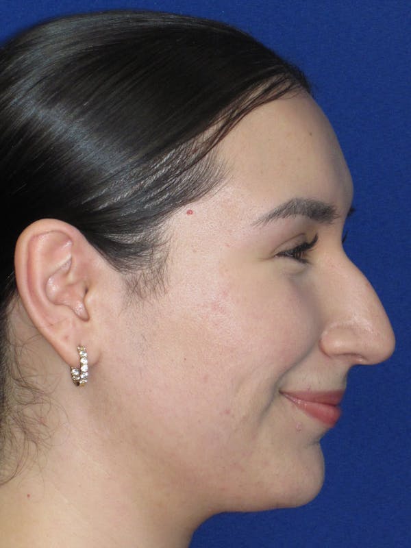Rhinoplasty Before & After Gallery - Patient 641626 - Image 7