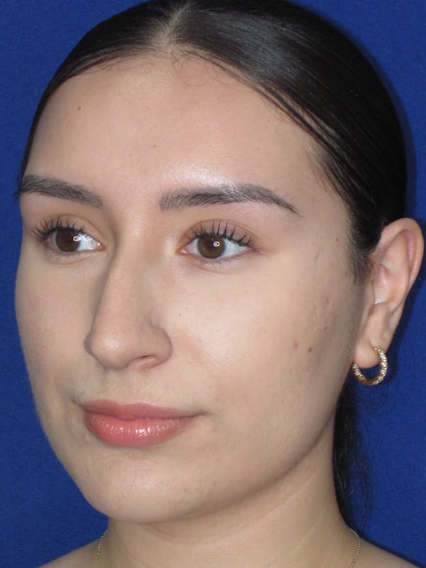 Rhinoplasty Before & After Gallery - Patient 641626 - Image 9
