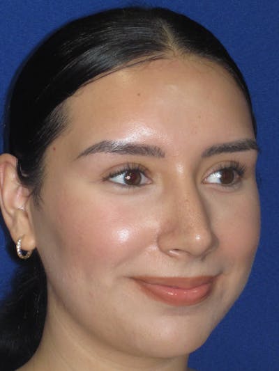 Rhinoplasty Before & After Gallery - Patient 641626 - Image 4