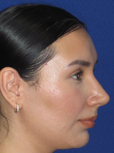 Rhinoplasty Before & After Gallery - Patient 641626 - Image 6