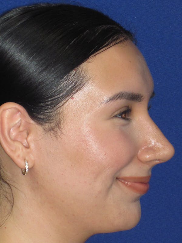 Rhinoplasty Before & After Gallery - Patient 641626 - Image 8