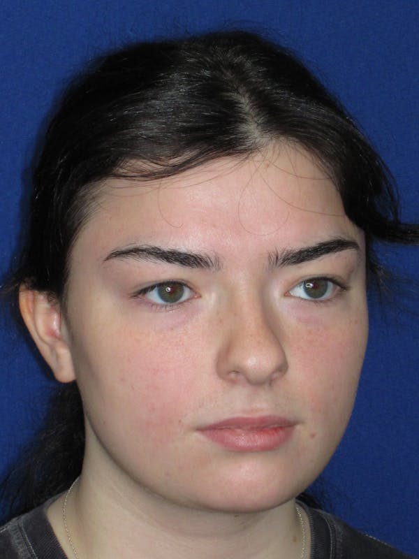 Rhinoplasty Before & After Gallery - Patient 244407 - Image 3