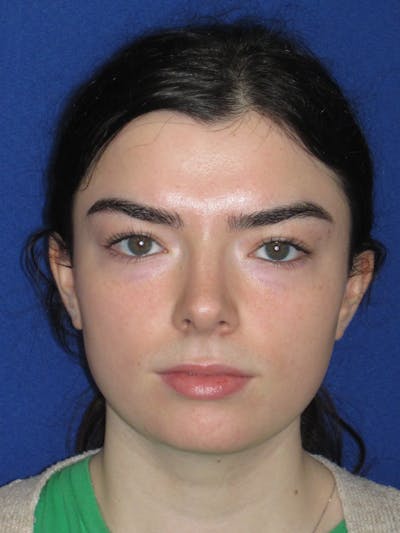 Rhinoplasty Before & After Gallery - Patient 244407 - Image 2