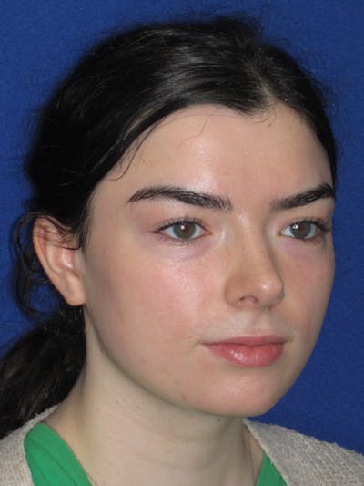 Rhinoplasty Before & After Gallery - Patient 244407 - Image 4