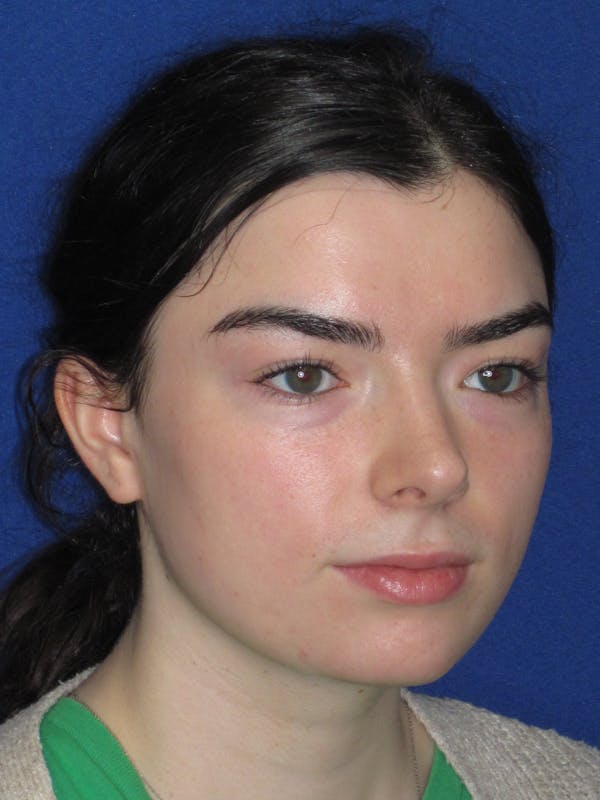 Rhinoplasty Before & After Gallery - Patient 244407 - Image 4