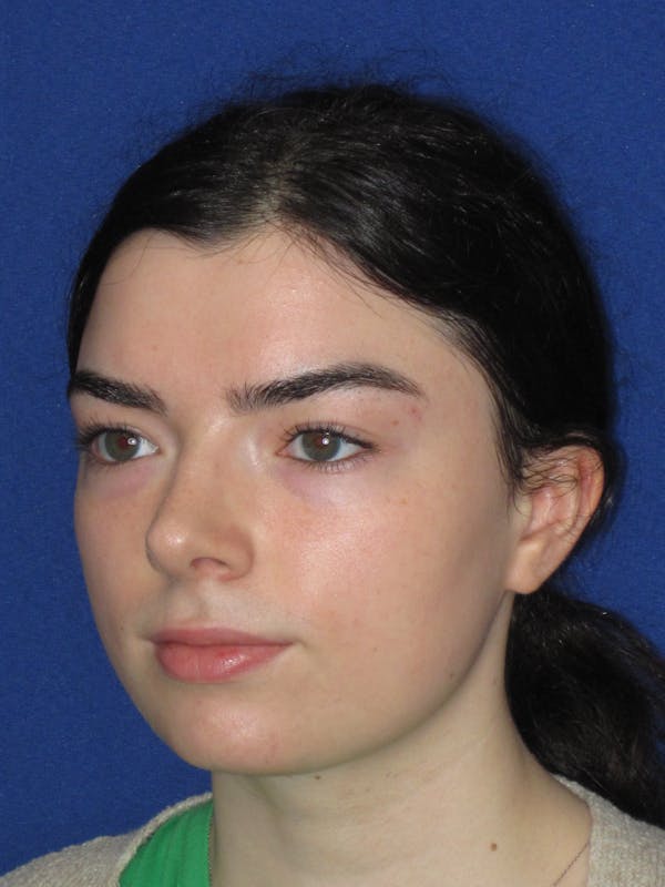 Rhinoplasty Before & After Gallery - Patient 244407 - Image 6