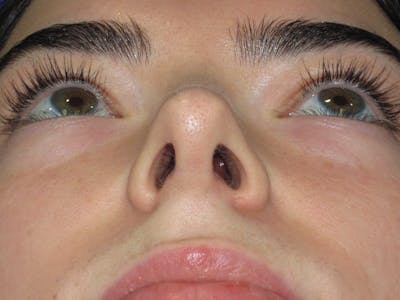 Rhinoplasty Before & After Gallery - Patient 244407 - Image 8