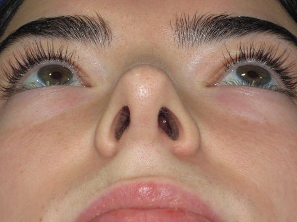 Rhinoplasty Before & After Gallery - Patient 244407 - Image 8