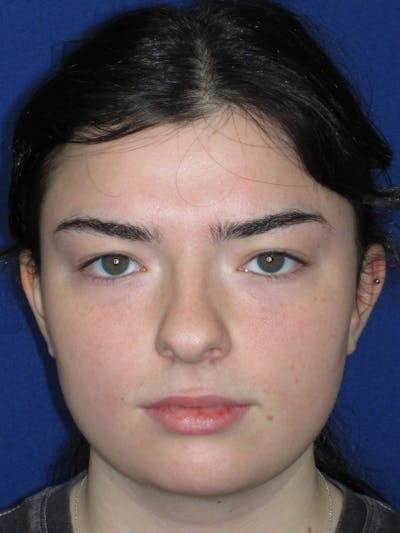 Rhinoplasty Before & After Gallery - Patient 244407 - Image 1